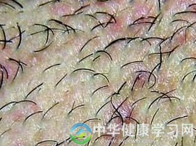什么是外阴毛囊炎？如何防治外阴毛囊炎？